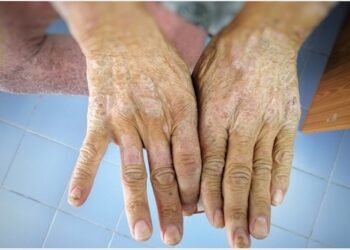 Scleroderma: a szervezet kötőszöveteit támadja meg